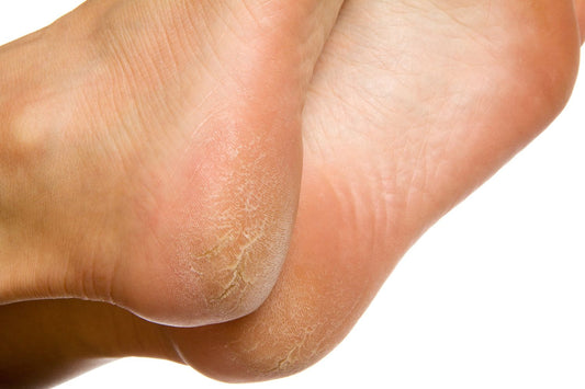Dry Cracked Heels